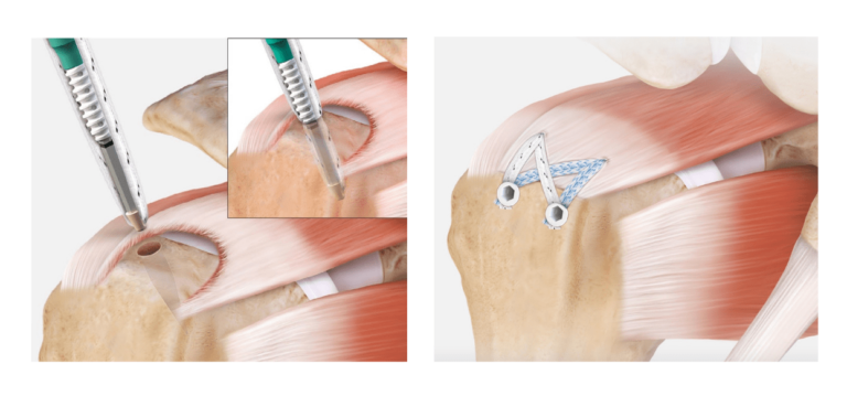 Rotator Cuff Tear Arthroscopic Surgery