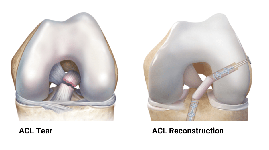 ACL Tear Information  Tennessee Orthopaedic Alliance