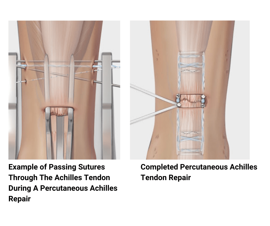 Achilles Tendon Ruptures Dr Edward S Chang Md