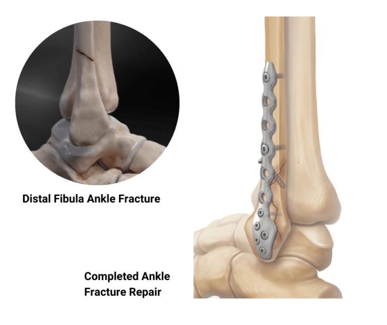 distal fibula fracture