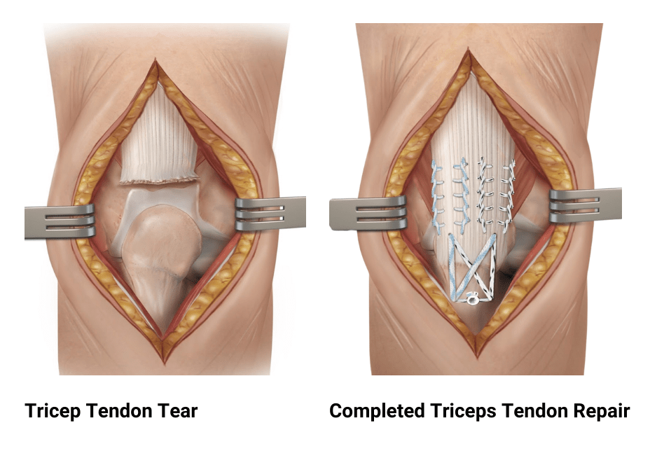 distal-triceps-tendon-ruptures-dr-edward-s-chang-md