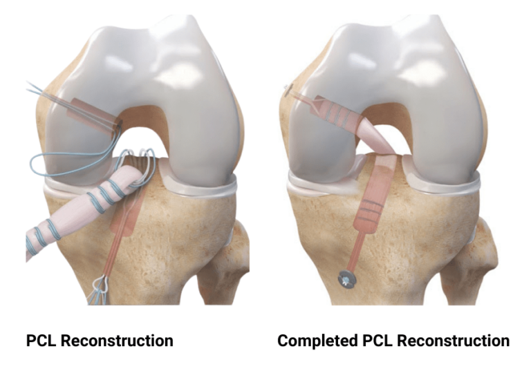 posterior-cruciate-ligament-pcl-tears-dr-edward-s-chang-md